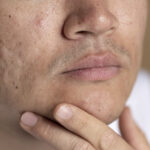 Perawatan Kulit Bopeng