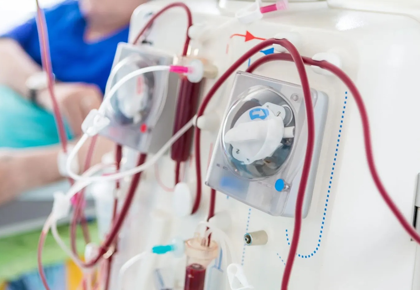 BPJS tanggung biaya cuci darah