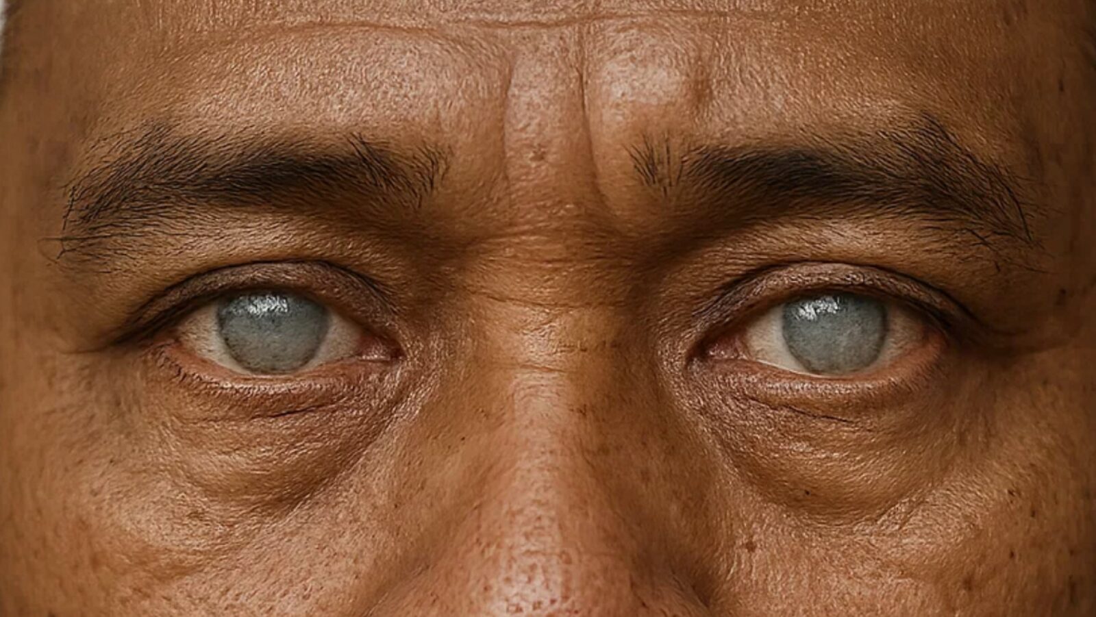 Biaya Operasi Katarak