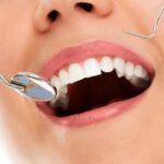 Scaling Gratis Pakai BPJS Kesehatan, Ini Syarat dan Prosedurnya