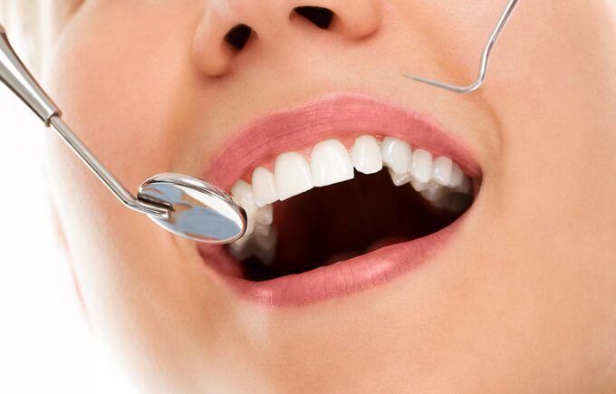 Scaling Gratis Pakai BPJS Kesehatan, Ini Syarat dan Prosedurnya