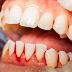 Makanan pencegah gusi berdarah