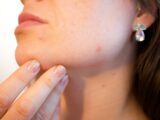 Beneran Gak Sih, Sering Cuci Muka Malah Bikin Jerawatan?