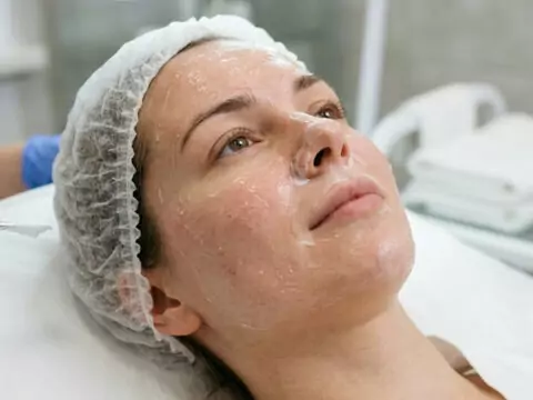 Chemical peeling