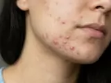 Tips Mengatasi Jerawat Hormonal Saat Haid agar Cepat Kempes