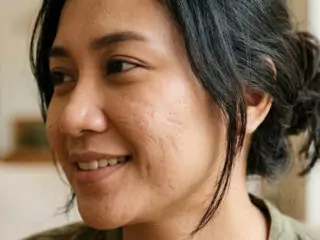 Menghilangkan Bopeng